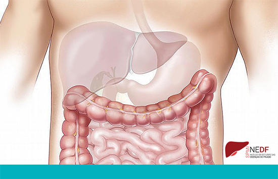 Curso Cirrose Hepática e suas complicações