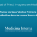 Tumor do Saco Vitelino Primário do Mediastino Anterior numa Jovem Adulta