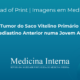 Tumor do Saco Vitelino Primário do Mediastino Anterior numa Jovem Adulta